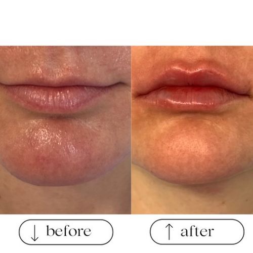 Before & After Treatment Results at Medical Aesthetic Center of Georgia in Macon, GA