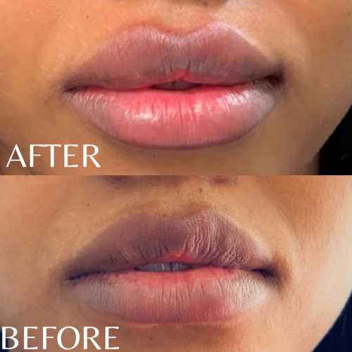 Before & After Treatment Results at Medical Aesthetic Center of Georgia in Macon, GA