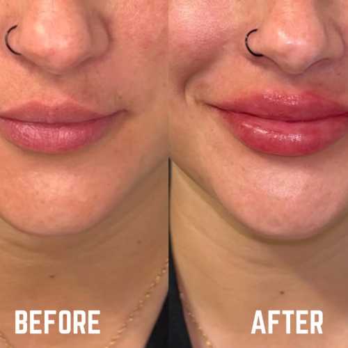 Before & After Treatment Results at Medical Aesthetic Center of Georgia in Macon, GA