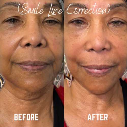 Before & After Treatment Results at Medical Aesthetic Center of Georgia in Macon, GA