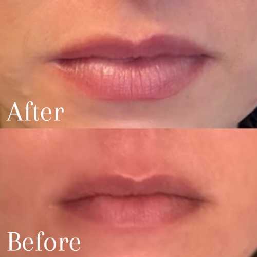 Before & After Treatment Results at Medical Aesthetic Center of Georgia in Macon, GA