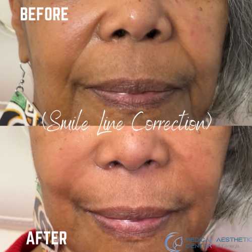 Before & After Treatment Results at Medical Aesthetic Center of Georgia in Macon, GA