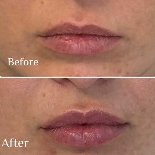Before & After Treatment Results at Medical Aesthetic Center of Georgia in Macon, GA