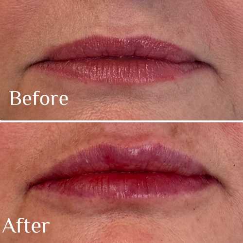 Before & After Treatment Results at Medical Aesthetic Center of Georgia in Macon, GA