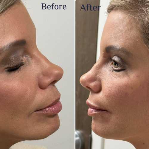 Before & After Treatment Results at Medical Aesthetic Center of Georgia in Macon, GA