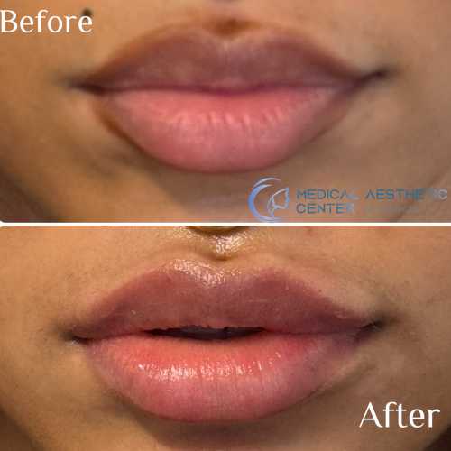 Before & After Treatment Results at Medical Aesthetic Center of Georgia in Macon, GA
