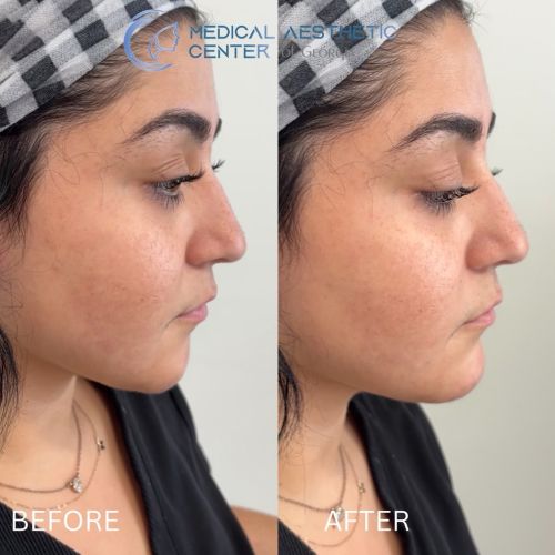 Before & After Treatment Results at Medical Aesthetic Center of Georgia in Macon, GA