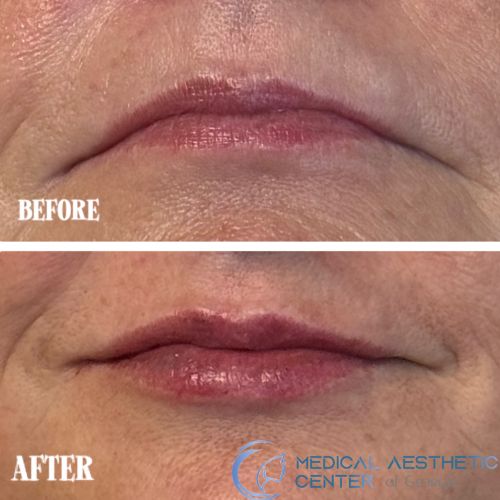 Before & After Treatment Results at Medical Aesthetic Center of Georgia in Macon, GA