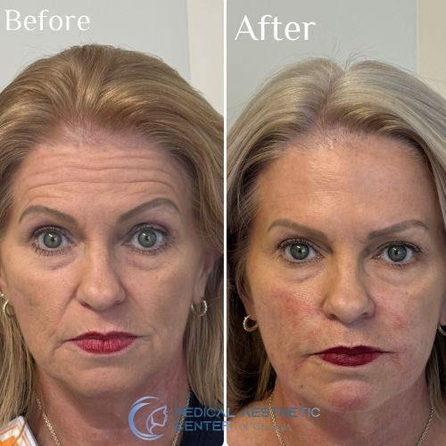 Before & After Treatment Results at Medical Aesthetic Center of Georgia in Macon, GA
