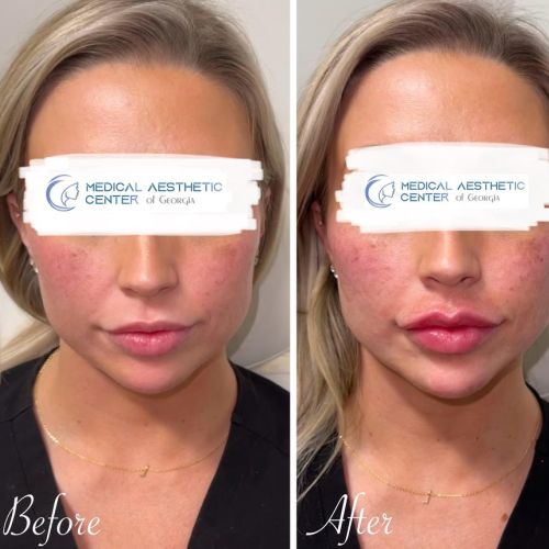 Before & After Treatment Results at Medical Aesthetic Center of Georgia in Macon, GA