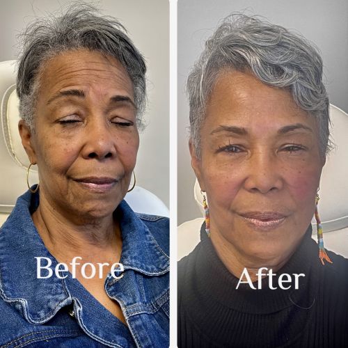 Before & After Treatment Results at Medical Aesthetic Center of Georgia in Macon, GA