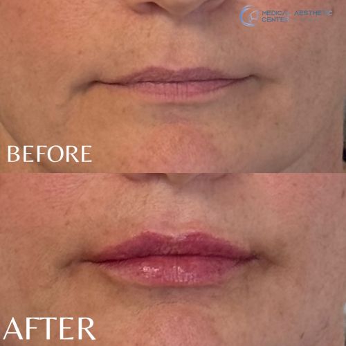 Before & After Treatment Results at Medical Aesthetic Center of Georgia in Macon, GA