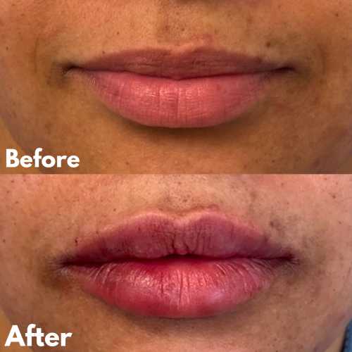 Before & After Treatment Results at Medical Aesthetic Center of Georgia in Macon, GA