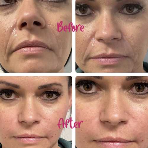 Before & After Treatment Results at Medical Aesthetic Center of Georgia in Macon, GA